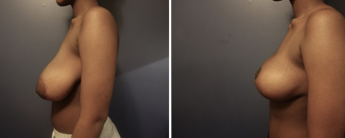 Before-AFter-Breast-Reduction-with-Lift-11