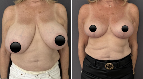 Before-AFter-Breast-Reduction-with-Lift-12