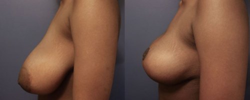 Before-AFter-Breast-Reduction-with-Lift-2