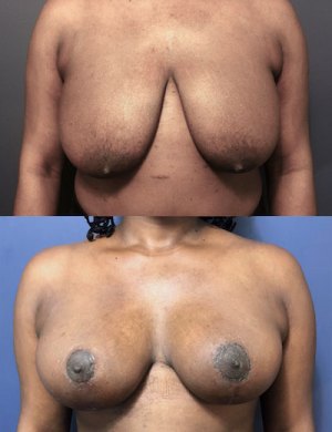 Before-AFter-Breast-Reduction-with-Lift-3