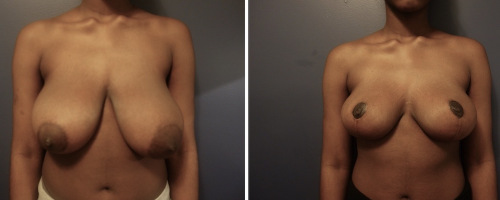 Before-AFter-Breast-Reduction-with-Lift-4