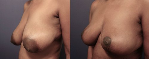 Before-AFter-Breast-Reduction-with-Lift-6