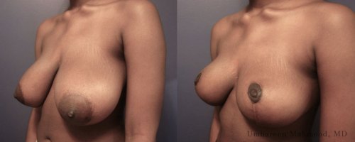 Before-AFter-Breast-Reduction-with-Lift-7