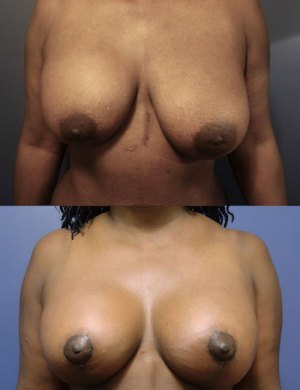Before-AFter-Breast-Reduction-with-Lift-9