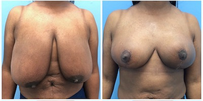 Before-AFter-Breast-Reduction-with-Lift
