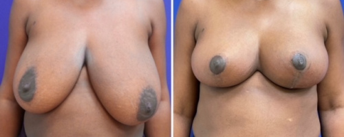 Before-After-Breast-Reduction-15