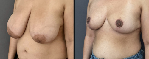 Before-After-Breast-Reduction-NYC-16