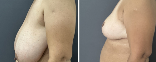 Before-After-Breast-Reduction-NYC-17