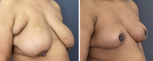 Before-After-Breast-Reduction-NYC-18