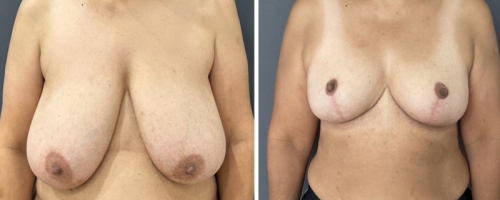 Before-After-Breast-Reduction-NYC-19