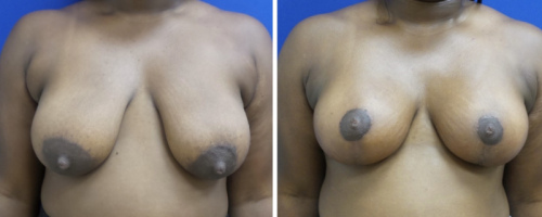 Before-After-Breast-Reduction-Plastic-Surgery-NYC-1