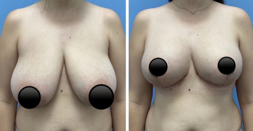 Before-After-Breast-Reduction-plastic-surgery-NYC-20