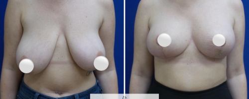 Breast-reduction-before-and-after-photo-032723-1