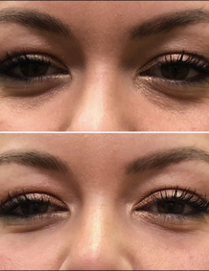 Before-After-Eye-fillers-2