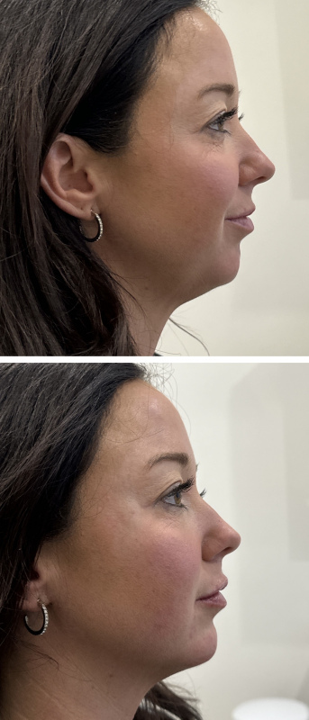 facial-balancing-nyc-73