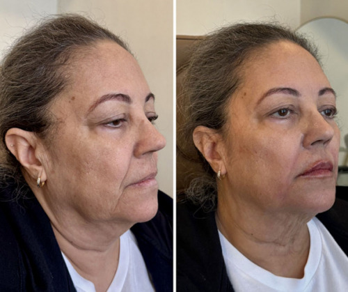 facial-balancing-nyc-75