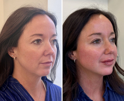 facial-balancing-nyc-80