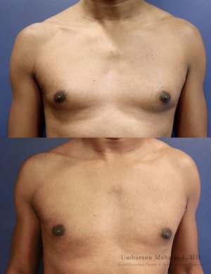 before-after-gynecomastia-1