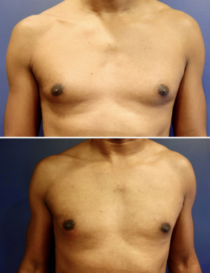 before-after-gynecomastia-2