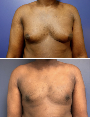 before-after-gynecomastia-3