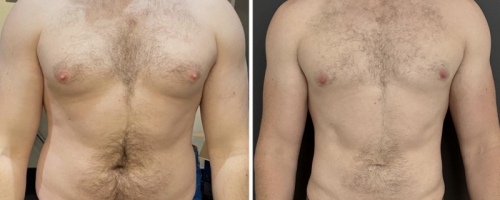 before-after-gynecomastia-abdomen-liposuction-plastic-surgery-10