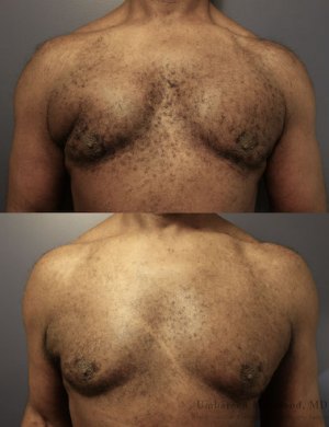 before-after-gynecomastia
