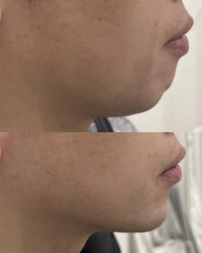 1_fillers-jawline-before-after-13