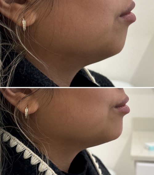 fillers-jawline-1