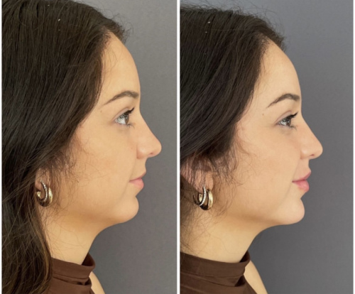 fillers-jawline-3