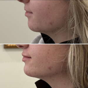 fillers-jawline-before-after-12