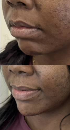 fillers-jawline-before-after-14