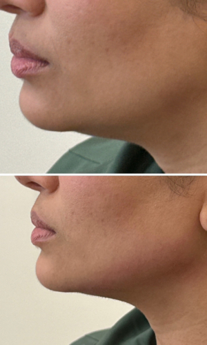 fillers-jawline-before-after-9