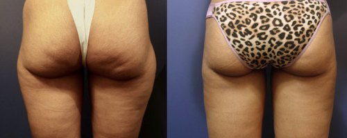 Before-After-Liposuction-Legs-