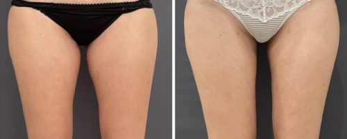 Before-After-Liposuction-Legs-2