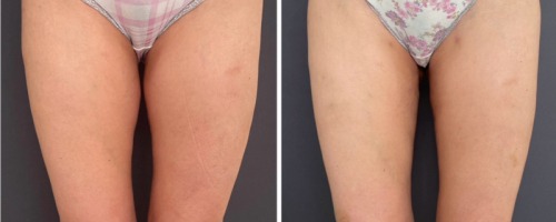 Before-After-Liposuction-Legs-3