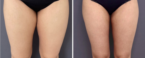 Before-After-Liposuction-Legs-4