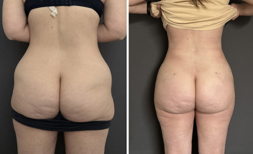 Before-After-Liposuction-Legs-5