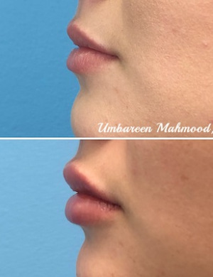 Before-AFter-Lip-FIllers-2