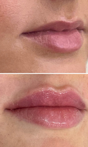 Before-Afte-Lip-Fillers-5