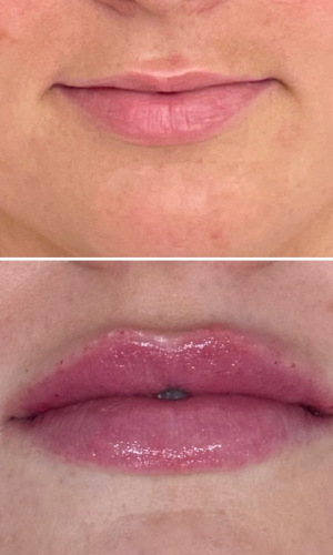 Before-Afte-Lip-Fillers-6
