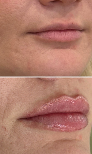 Before-Afte-Lip-Fillers-7