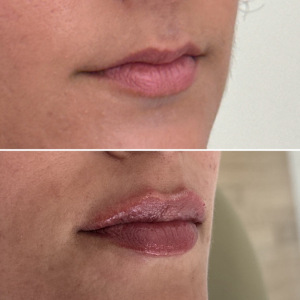 Before-Afte-Lip-Fillers-NYC-17