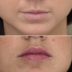 Before-Afte-Lip-Fillers-NYC-18