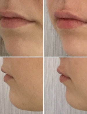 Before-Afte-Lip-Fillers