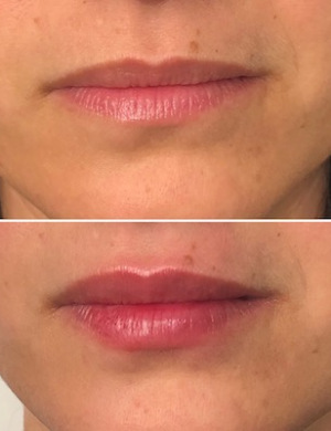 Before-After-Lip-Fillers
