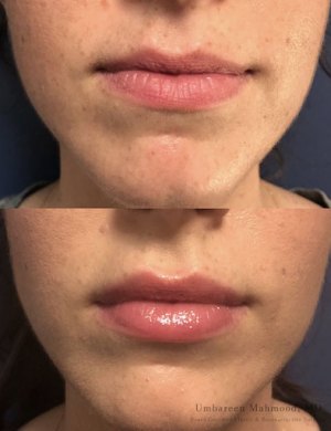 Before-After-lip-fillers-3