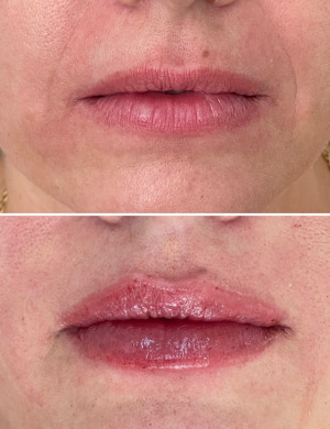 Lip-filler-before-and-after-photo-032723-1