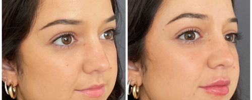 Lip-filler-jawchinfiller1-before-and-after-photo-032723-1