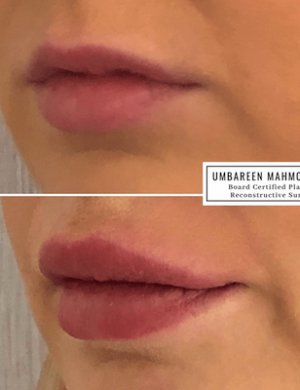 fillers-lip-augmentation-min