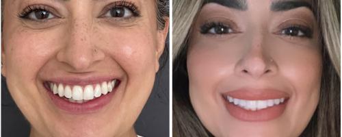 lip-filler-before-and-after-photo-032723-3